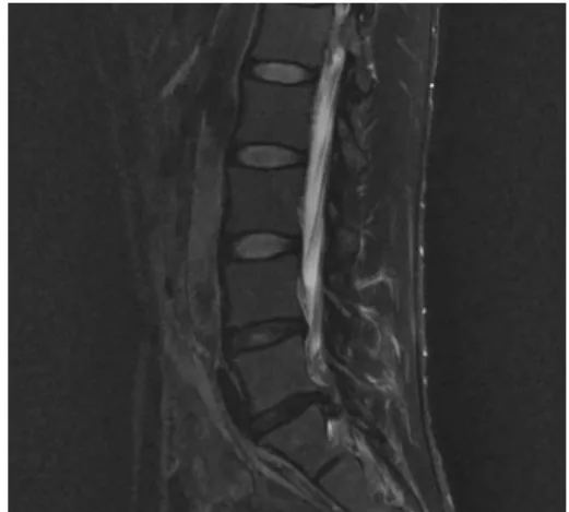 Fig. 1. L-Spine MRI with CTL (2014-08-03). 11. 입원치료 중 주요 복용약물 1) 한약복용약물(Table 2) 利痰 祛濕熱 작용을 하는 생간건비탕을 간기능 손상 방지를 위해 투여하는 동시에 허리 통증 치료를 위해 活血 祛瘀 通絡 止痛작용을 하는 청파전신방(白屈菜, 牛膝, 木瓜, 五加皮, 玄胡, 羌活, 蒼朮, 當歸, 乾地黃, 赤芍藥, 威靈仙, 獨 活, 陳皮, 沒藥, 乳香, 紅花, 砂仁, 甘草, 生薑, 大棗로 구성)과 청신바