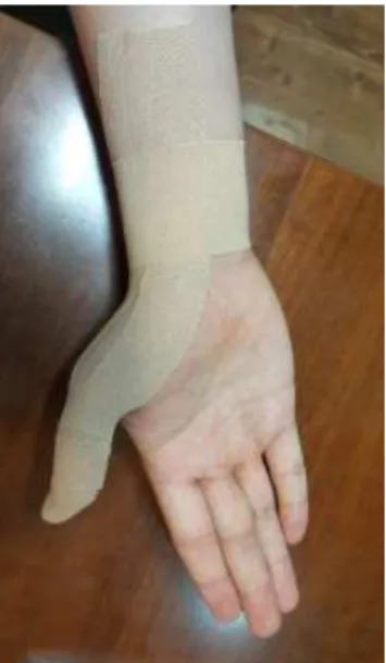 Fig. 3. Kinesiology tape treatment (inside).