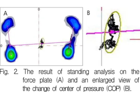 Fig. 2. The result of standing analysis on the force plate (A) and an enlarged view of the change of center of pressure (COP) (B).