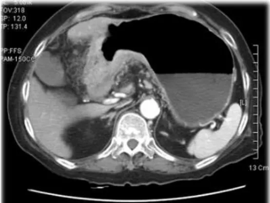 Fig. 5. Abdominal computed tomography scan presents huge gastric dilatation and almost completely obstruction of pylorus-duodenum channel (case 3)