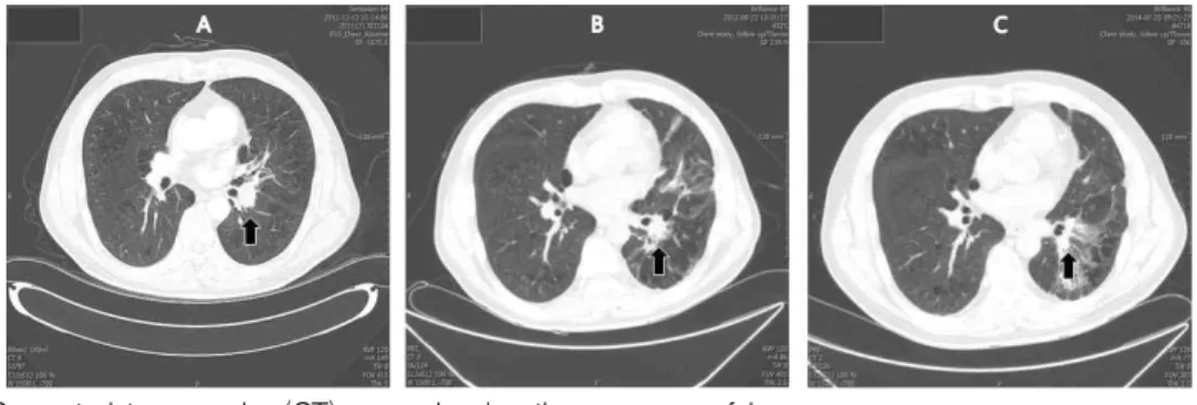 Fig. 1. Computed tomography (CT) scan showing the response of lung cancer.