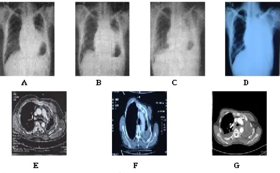 Fig. 1. The change of chest x-ray and chest CT in case 1.