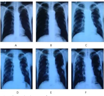 Fig. 2. The change of chest radiography in case 2.