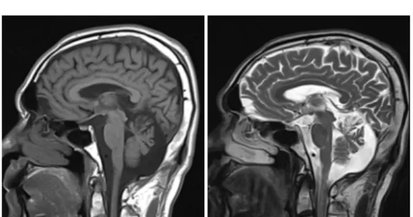 Fig. 1. Brain MRI T1 &amp; T2 sagittal section.