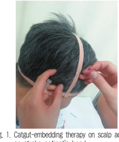 Fig. 1. Catgut-embedding therapy on scalp acupoints  on stroke patient’s head.
