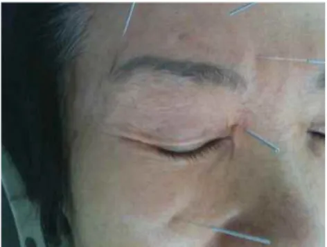 Fig. 2. It shows how the researcher applied acupuncture at each acupoints around the eye of patients.