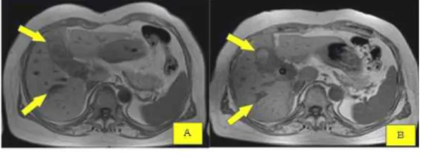Fig. 2. CT, dynamic Biliary follow up.