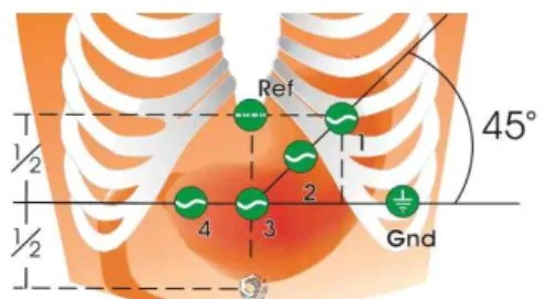 Fig. 2. The placement of electrogastrography electrodes.