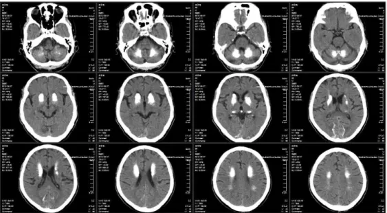 Fig. 1. Brain CT of the patient.