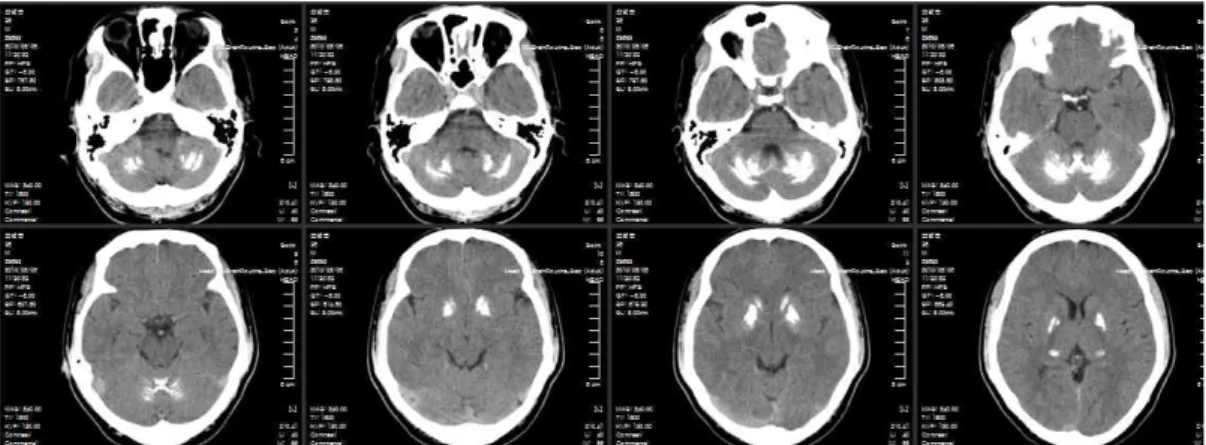 Fig. 3. Brain CT of the patient`s 30-year-old son.