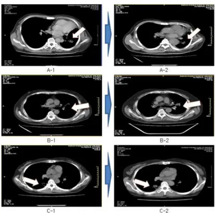 Fig. 1. Chest CTs of the cases treated with Hang-Am Plus.