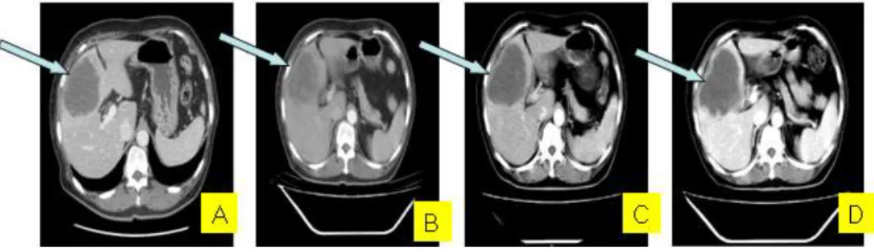 Fig. 1. Abdominal Computed Tomography Follow up (Case 1).
