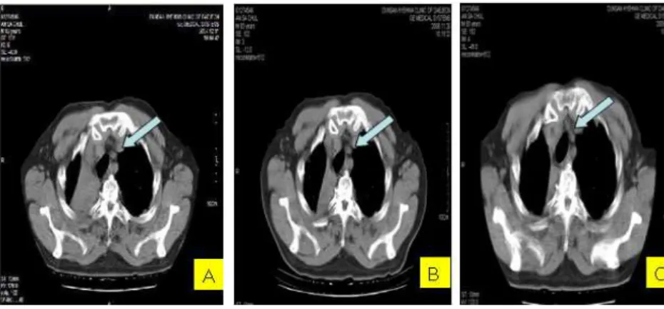 Fig. 3. Chest CT of AnOO.