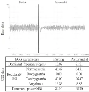 Fig. 1. Typical case of a 46year old female patient complained of severe headache and dyspepsia.