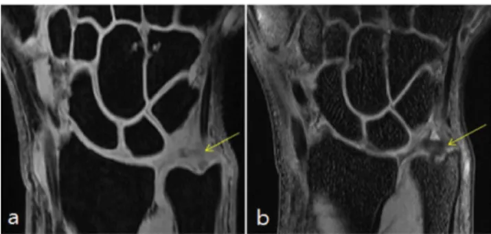 Fig. 7. (Color online) Comparing the TFCC injury (arrow) on images by fat suppressed 3D FSPGR T1 (a) and fat suppressed Isotropic 3D FSE T1 (b), respectively.