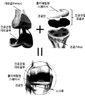 Fig. 2. Total  Knee  Replacement (TKR) surgery.