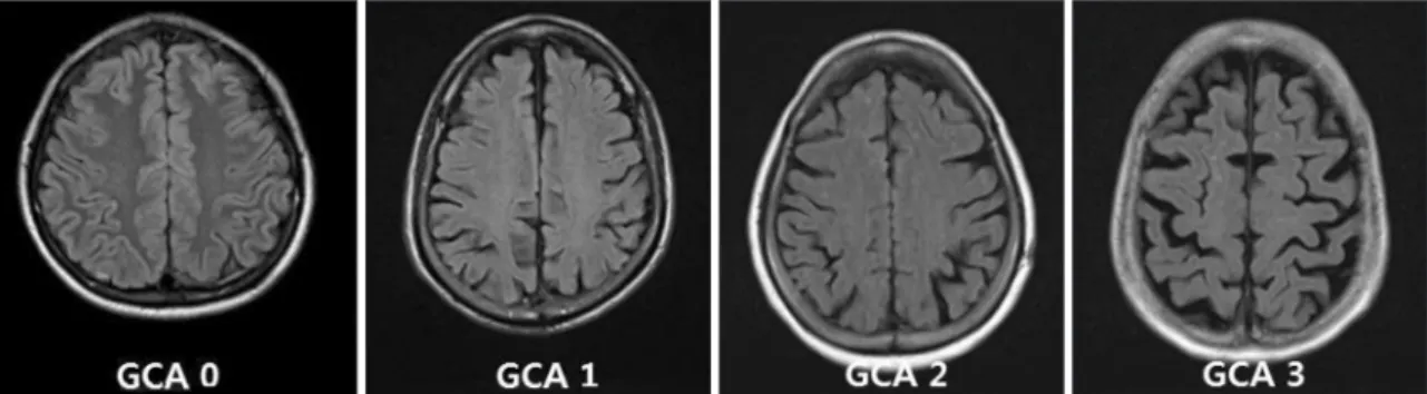 Fig. 1. GCA scale for global cerebral atrophy. GCA : global cerebral atrophy.