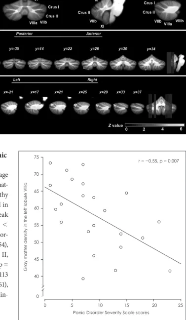 Fig. 1. Voxel-based morphometry  comparisons between the panic  disorder group and healthy  individ-uals