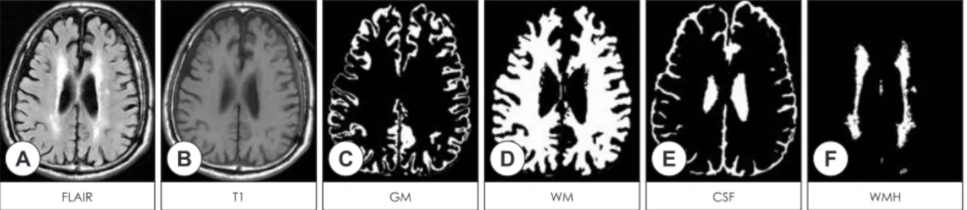 Fig. 1. Example of (A) fluid attenuated inversion recovery and (B) T1-weighted images including white matter hyperintensities (WMH) on  axial plane and segmentation results on the same slice [(C) gray matter, (D) white matter, (E) cerebrospinal fluid space