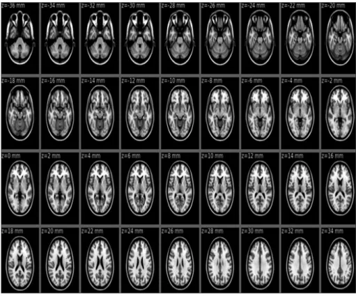 Table 2. Brain regions of significantly reduced gray matter volume in MCI patients compared to control group (Control ＞ Patients, FWE  corrected p ＜ 0.01)