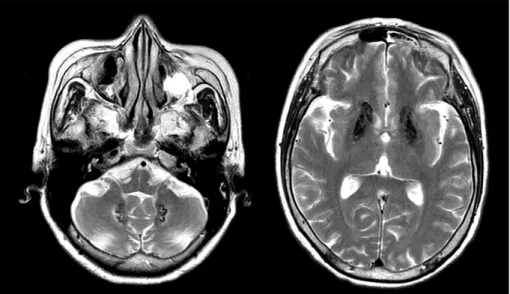 Fig. 1. T2-weighted brain magnetic image showing multifocal diffuse low signal intensity lesions in bilateral basal ganglia, dentate nucleus, and thalamus