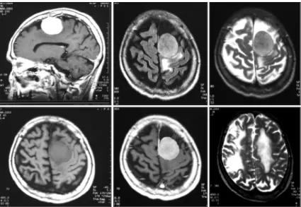 Fig. 1. MRI findings of the patient with manic symptom as a presenting symptom. 4×4cm size, extra-axial mass with  homogenous enhancement was seen in the left high convexity of frontal lobe