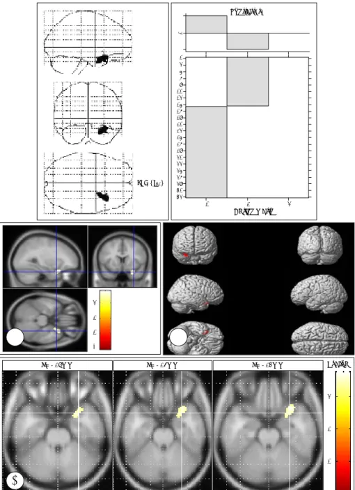 Fig. 1. Brain regions where rCBF was lower in the TBI group(n=28) compared with the normal control(n=15)
