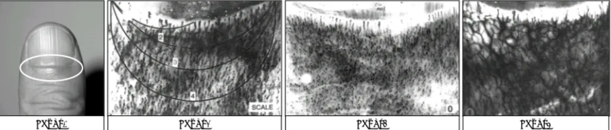Fig. 1. Plexus Visibility Rating Scale. Panel 1：The usual field of nailfold observation is shown by the circle(The nail’s  proximal edge is positioned at the top of each photo in panel 2, 3 and 4；plexus is the netlike vascular  structure near that edge)