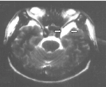 Fig. 1. T2-weighted image of MRI shows ovoid-cystic lesion in the  middle cranial fossa