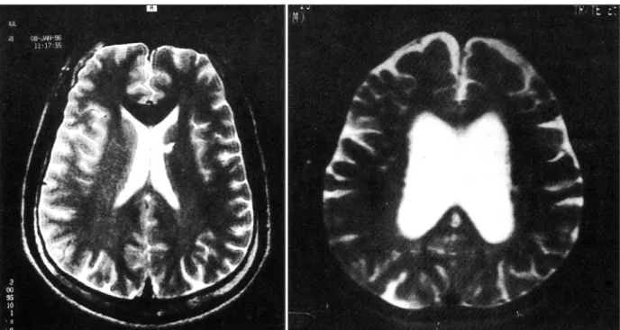Fig. 1. T2-weighted MR images demonstrates left single periventricular hyperintesity(left) and multiple periventicular and deep  white matter hyperintensities(right)