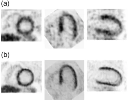 Fig. 1.7 (a) Sample images from one of the eight cardiac gates from selected sample (Left) short- short-axis, (Middle) horizontal long-short-axis, and (Right) vertical long-axis slices images obtained using a 3D OS-EM with no motion compensation from a 13 