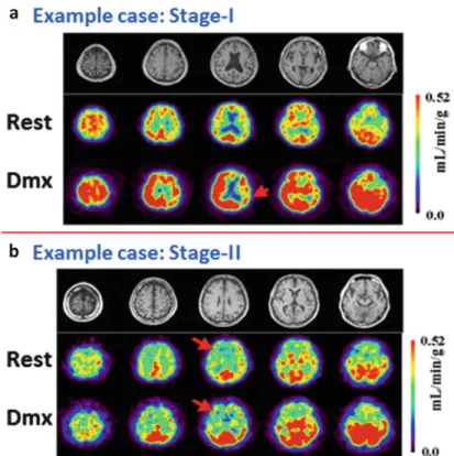 Fig. 2.7 MR and CBF images at rest and after acetazolamide stress assessed with 123 I-IMP and the dual-table ARG method on two typical low-risk patients (stage I) and a patient with high-risk (stage II) ischemia (Figure is from Iida et al