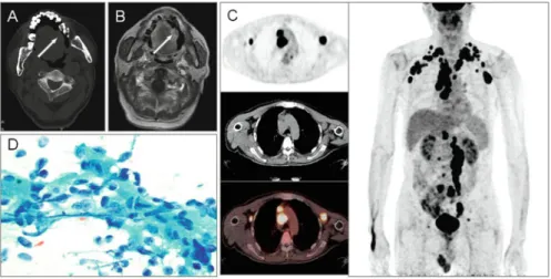 Fig. 22.3 (a) CT imaging detected a mass located in the left edge of the tongue (arrow)