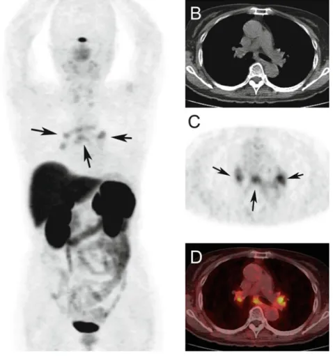 Fig. 23.4 A 65-year-old woman with suspected sarcoidosis. A maximum intensity projection image (a) and axial CT (b), DOTATOC PET (c), and fused (d) images are shown