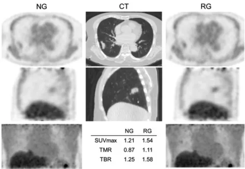 Fig. 25.4 Images of an 87-year-old female with stage II NSCLC in the right lower lobe