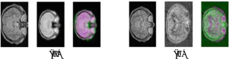 Fig. 1. MRI/X brain image registration: (a) mono-modal MRI/MRI atlas (from left to right: MRI image, MRI atlas and superposed images), (b) multi-modal MRI/PET (from left to right: MRI image, PET image and superposed images).
