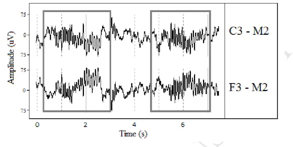 Figure 1. Sleep spindles seen over both central (C3) and frontal (F3) EEG derivations in stage  2 sleep in an adolescent (15yrs)