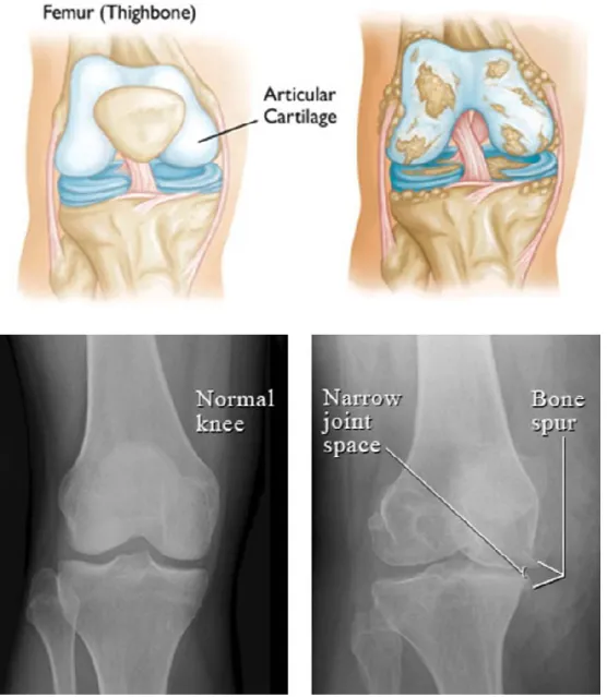 圖 2- 4  正常與骨關節炎之膝關節比較 