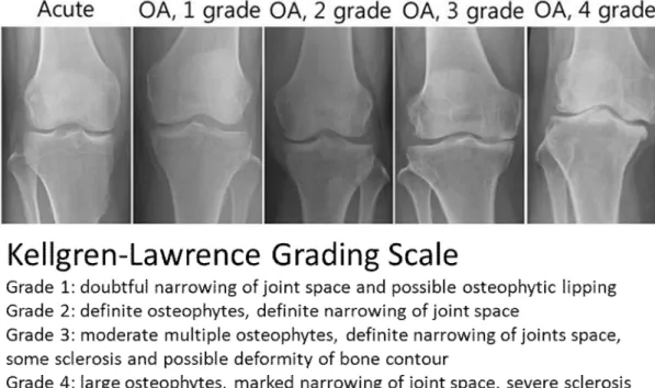 圖 2- 5  膝關節骨關節炎 X 光診斷分類標準 