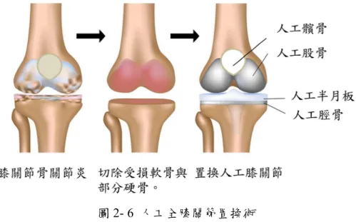 圖 2- 6  人工全膝關節置換術 