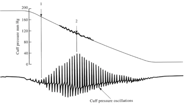 圖  2–6、振盪法示意圖  電子式血壓計所使用之振盪法（Oscillation method），如圖  2–6 所 示，是多數電子血壓計最常使用的技術，其工作原理類似聽診法，不同 的是須使用壓力感測器來偵測壓脈袋內壓力變化，藉以判斷收縮壓、舒 張壓與平均壓。振盪法量測方式，一開始對壓脈袋充氣，當壓脈袋內壓 力大於人體的收縮壓後，再控制洩壓閥洩氣。在量測過程中，當壓力訊 號突然變大時，即為收縮壓，在壓力訊號振幅突然變小的點應為舒張壓。 但到目前為止，只有平均壓的點可以明確定義出來，收縮壓和舒張壓的 壓力訊號