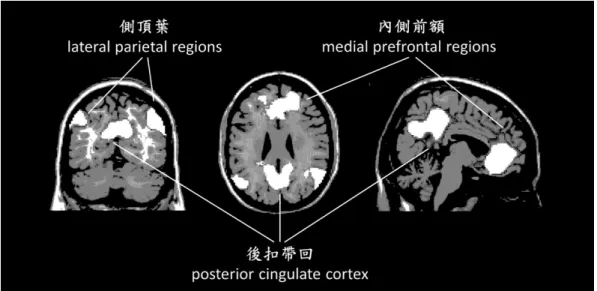 圖 3  靜息態功能性磁共振造影的預設模式網絡相關大腦區域 
