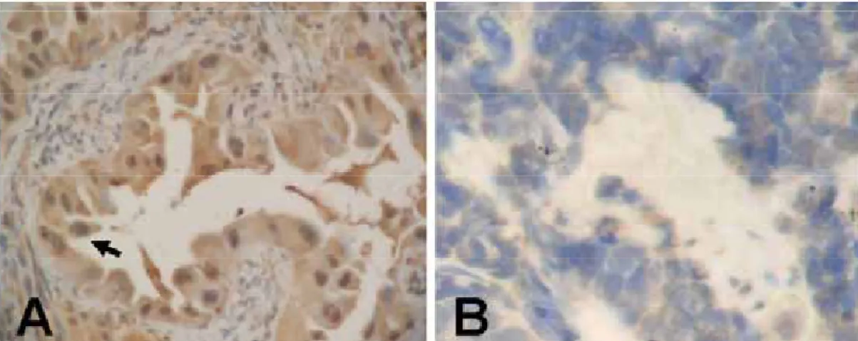 Figure 1. Immunohistochemical analysis of AXIN2 proteins in formalin-fixed paraffin-embedded sections of resected tumor 