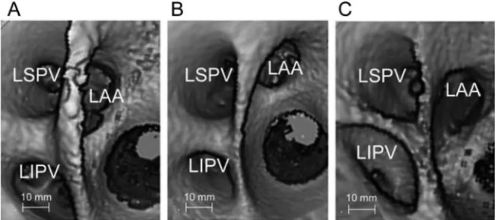 Figure 1 shows an example of the different LA sizes among the six age groups. In addition, aging also increased both anterior and posterior wall thickness after the patients became ⬎ 50 years old
