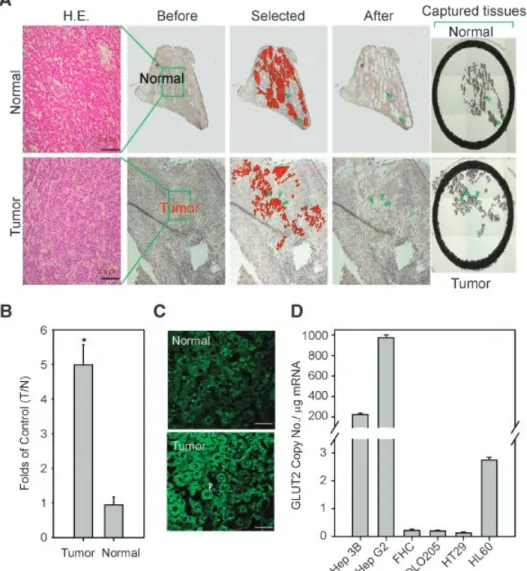 Figure 1. Determination of GLUT2 expression levels in LCM- LCM-isolated human hepatocellular carcinoma and normal liver cells
