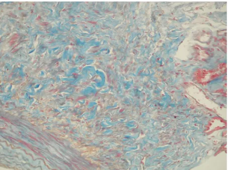 Fig. 3. Apparent interstitial expansion and fibrosis are also evident under masson-trichrome stain (light microscopy, masson-trichrome stains; original
