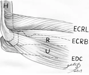 FIGURE 1. The injection was administered into the ECRB muscle near the common origin of the wrist and finger extensors at the  lat-eral epicondyle