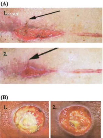 Figure 5. The healing process of chronic wounds (two cases, A and B) covered with SACCHACHITIN membranes
