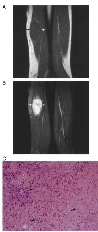 Fig. 1. Images of a neurofibroma of the ulnar nerve of the left arm in a 58-year-old man who had a long-standing palpable mass