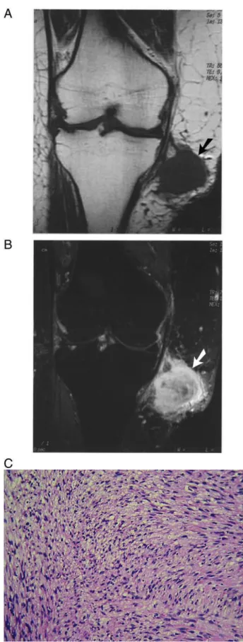 Fig. 3. Images of a malignant PNST involving the subcutis of the right knee in a 65-year-old woman